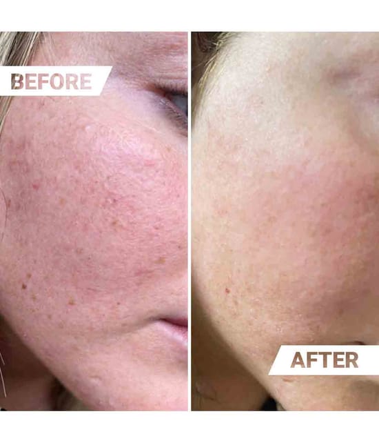 Produktbild 4 von 4, M1 SELECT NEEDLING Dermaroller